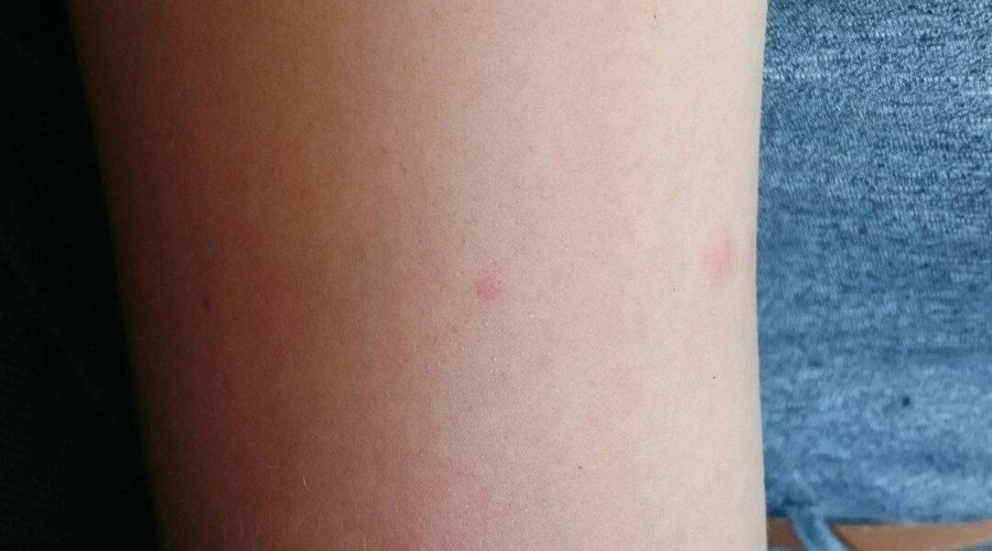 Bites caused by incest other than mosquitos in beds