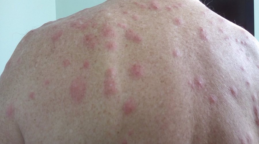 Bed bug bites suffered whilst staying at Le Manoir St Denis Montreal