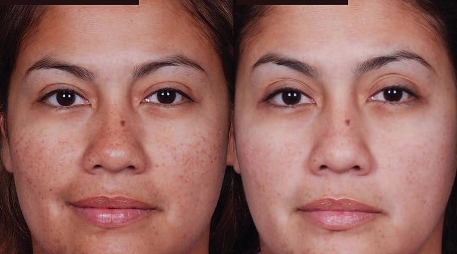 Pigmentation Solution @BorneoMedispa