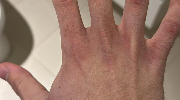 my freezing/broken skin hands due to the extreme cold!